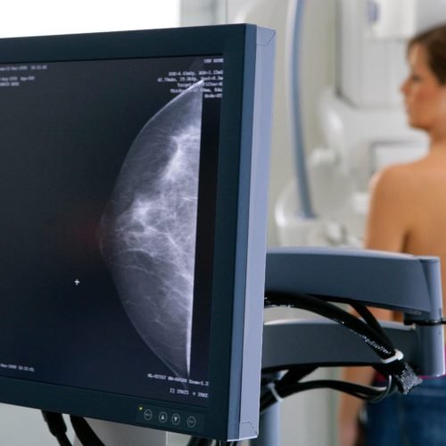 Mamografía (MG)